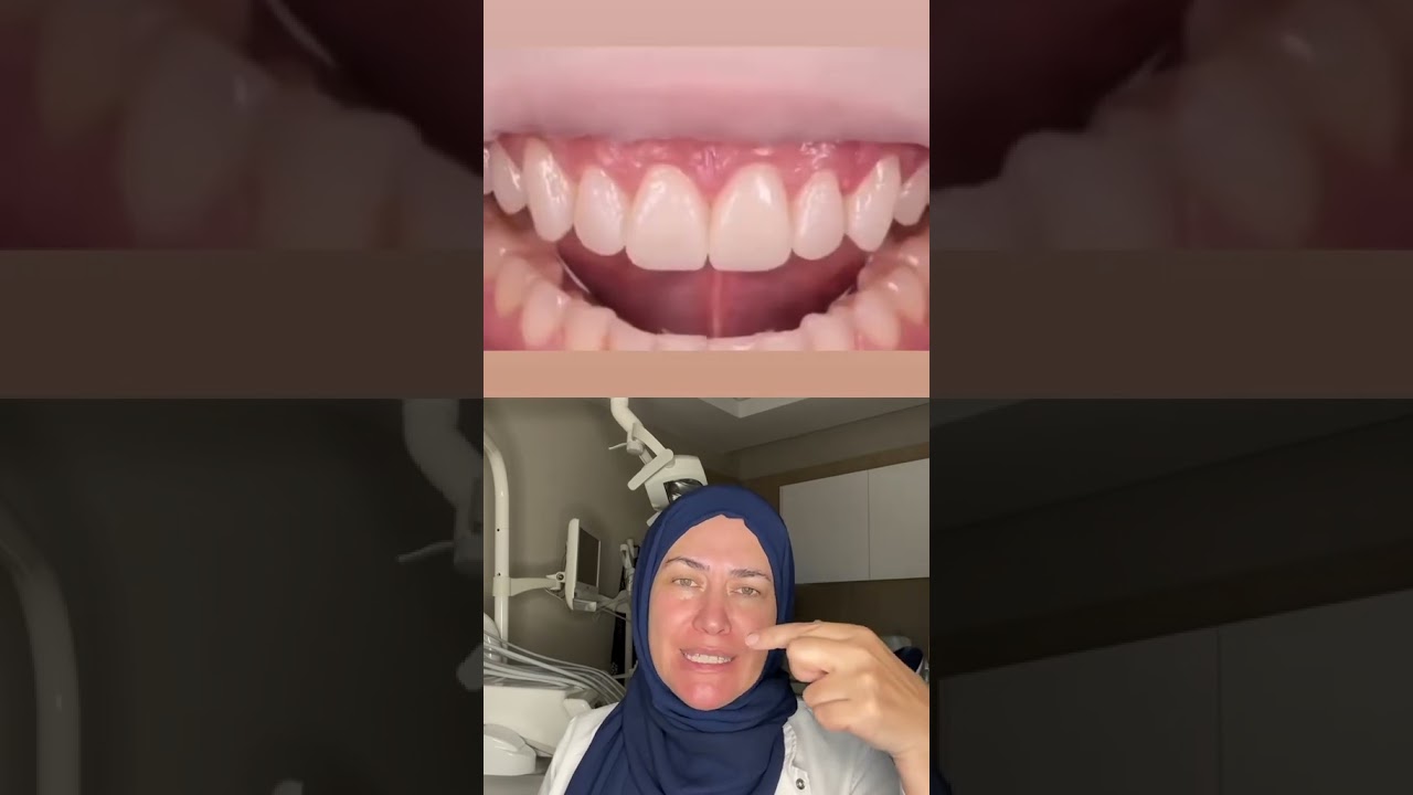 Dişlere başlamadan son haline görmek mümkün mü #dentist #smiledesigndental #laminediş #veneer