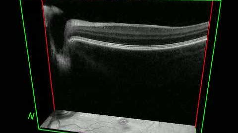 Spectralis Volume Scan