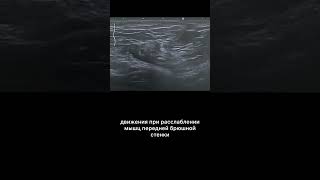 #узи #паховаягрыжа