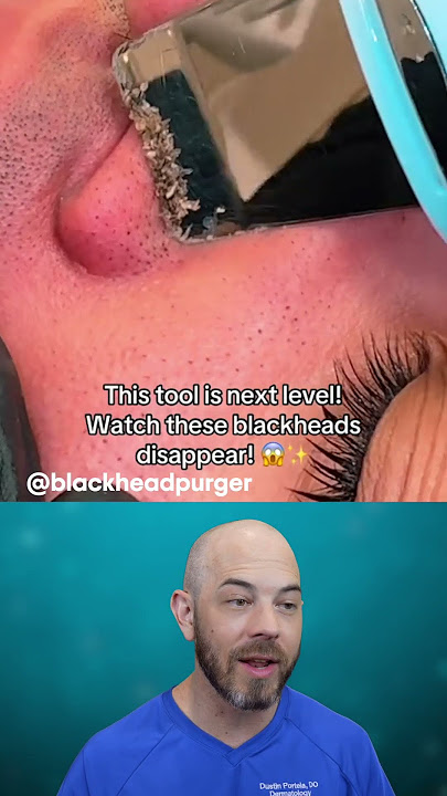Pore spatula to the rescue💥👊 (credit: @blackheadpurger on TT) #satisfying #pores #acne
