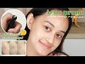 ACNE PRONE SKINCARE PAKE JARUM &amp; VITAMIN E? | CommonLabs Review