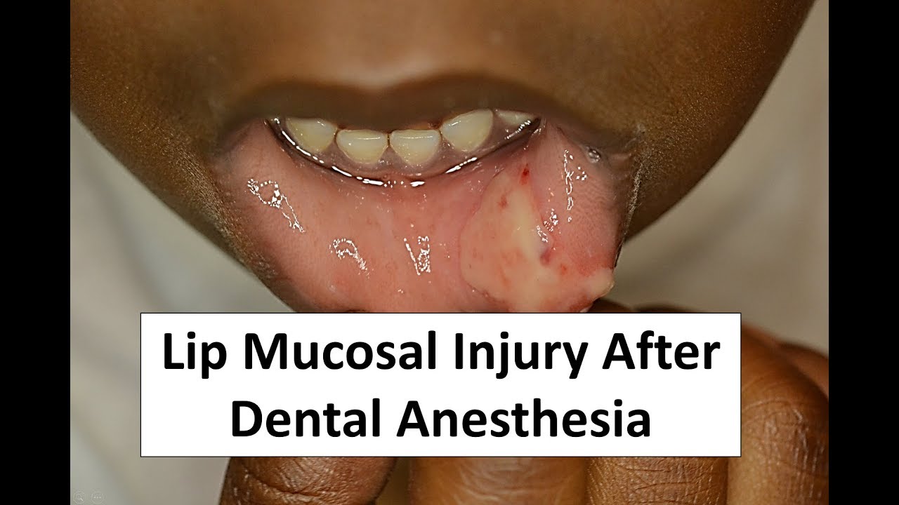 Lip Mucosal Trauma After Dental Anesthesia