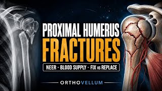 Proximal Humerus Fractures Masterclass: Neer Classification & PROFHER Evidence