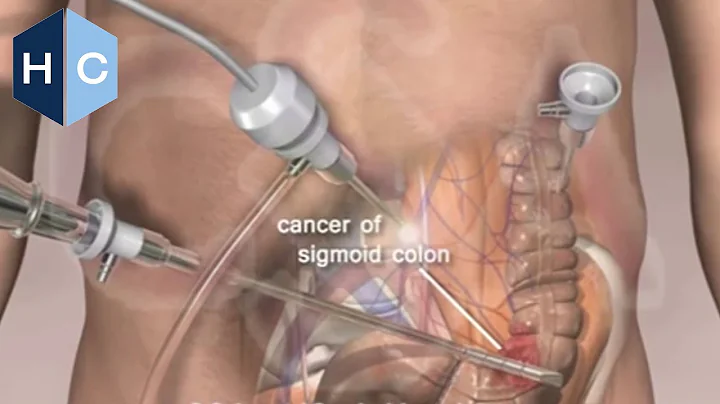 Laparoscopic Minimally Invasive Colon Surgery - Dr...