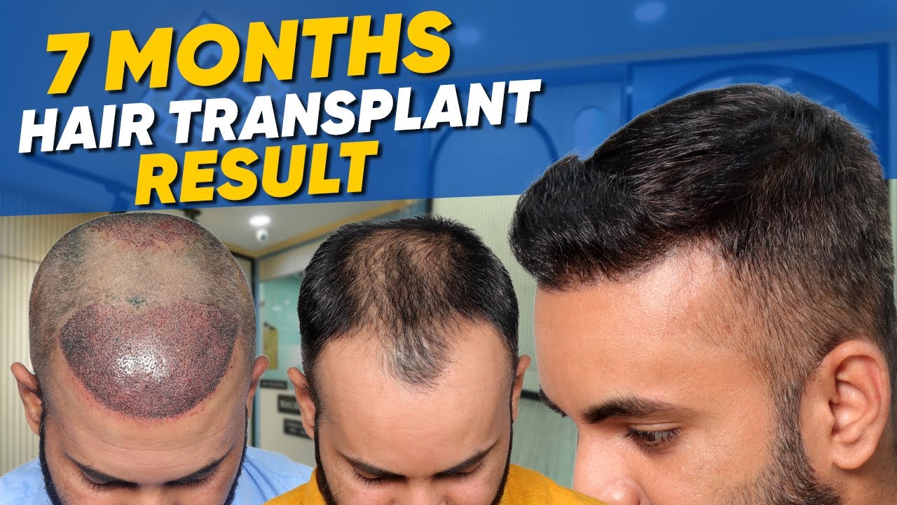 Hair Transplant in Switzerland Best Results & Cost of Hair Transplant