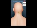 Understanding Mechanical Thrombectomy: A Life-Saving Stroke Treatment | Bajaj Technovision
