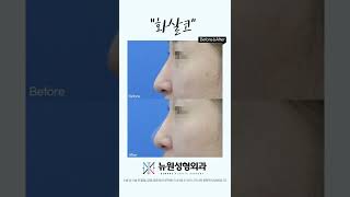#화살코 성형하면서 #매부리코 교정까지! 개인 맞춤 디자인으로 만족할 수 있는 #서면코성형
