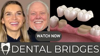 Dental Bridges: 2023 Comprehensive Guide to Dental Bridges including Patient Testimonials