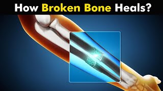 Process of Bone Healing | Bone Healing Steps (Urdu/Hindi) screenshot 5