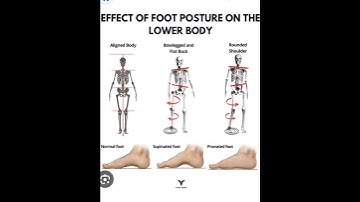 effect of foot alignment on posture #fitness #tips #medical #viral #trending #youtubeshorts