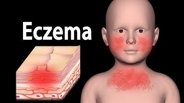 Eczema, Animation.