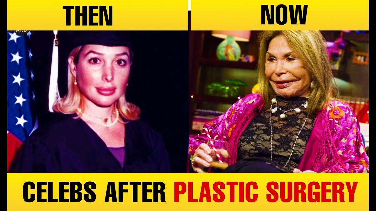 Celebrities After Worst Plastic Surgery, Then and Now 2025