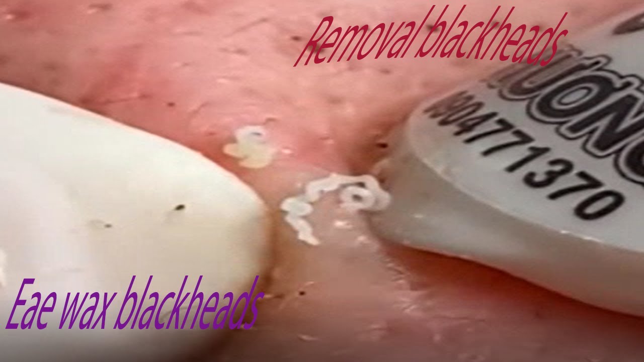 remove Blackhead# acuum Removal with built in camera for 