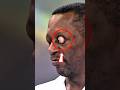 The Terrifying Reality of Exophthalmos Explained  #Exophthalmos #GravesDisease #Medical Animation