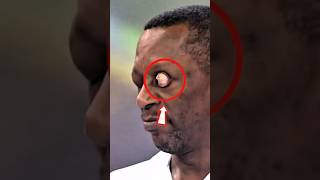 The Terrifying Reality of Exophthalmos Explained #Exophthalmos #GravesDisease #Medical Animation