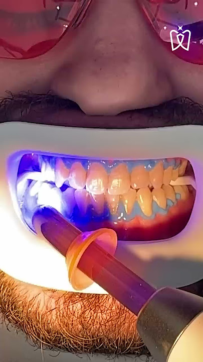 Teeth whitening process