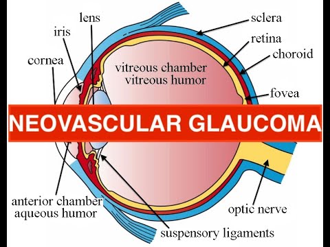 neovascular glaucoma - etiology, causes, course, treatment