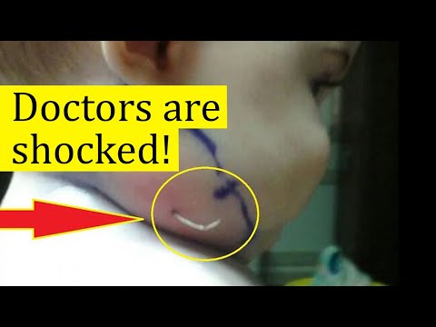 Видео: This little girl was constantly scratching her neck. The reason surprised even experienced doctors..