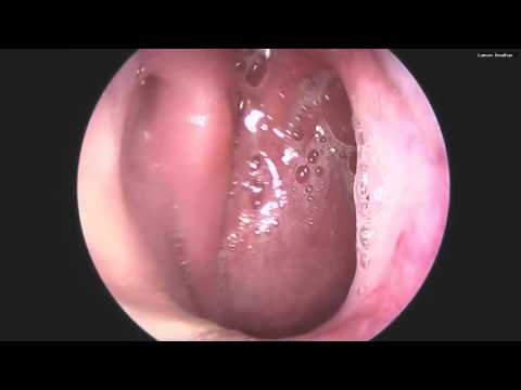 Video Endoskopi Hidung Icd 9