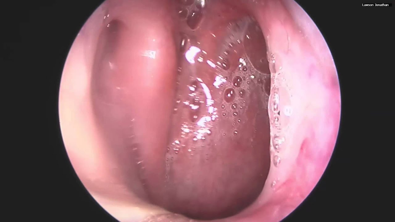 purulent nasal drainage