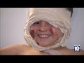 7-year-old boy burned in fire after science experiment with household items goes wrong