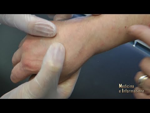 Video: Determinazione Dello Stadio Del Melanoma, Prognosi