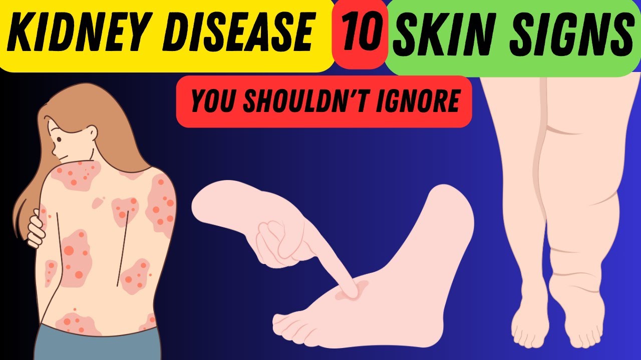 10 Skin Signs of Kidney Disease: What Your Skin is Trying to Tell You ...