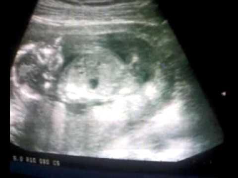Dziecko W Brzuchu Usg YouTube dziecko-w-brzuchu-usg-youtube