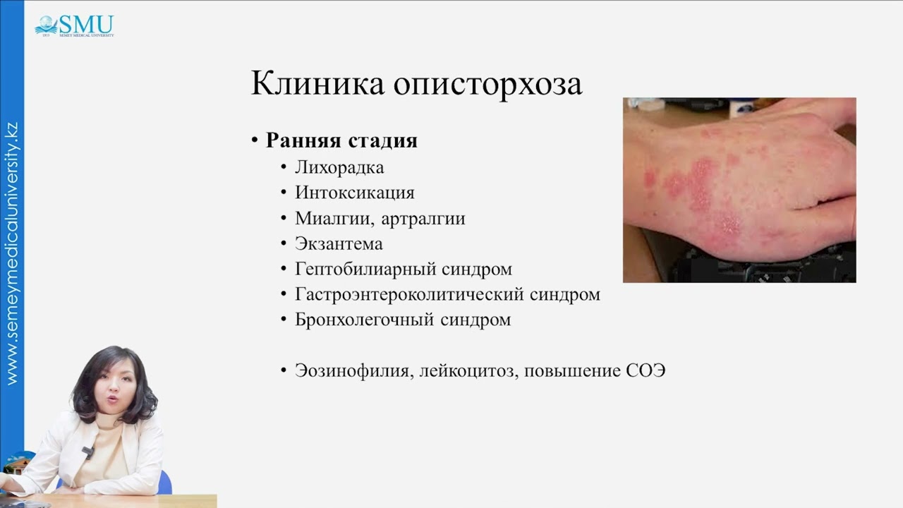 Трематодозы