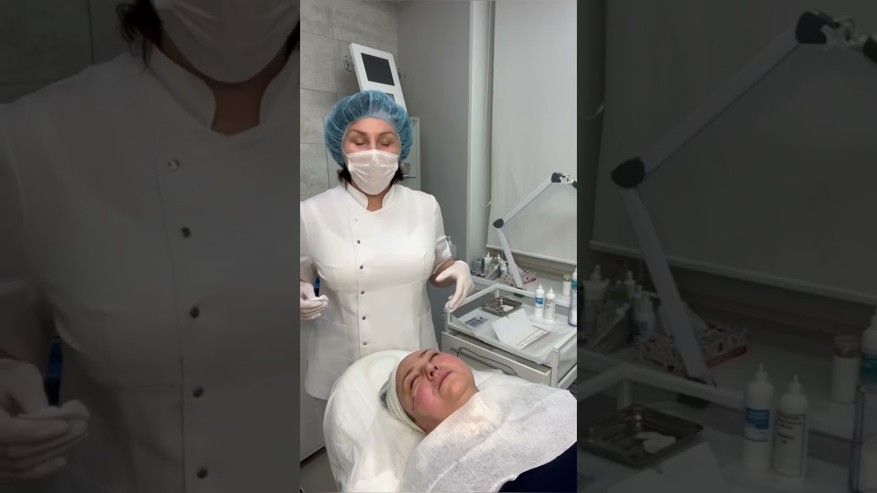 #Тредлифтинг лица нитями #Аптос