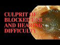 CULPRIT OF BLOCKED EAR AND HEARING DIFFICULTY