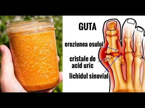 🍀Spuneti adio gutei cu acest tratament natural foarte eficient!🔔