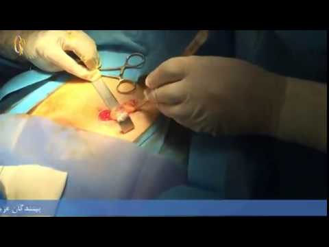 عمل جراحی باز واریکوسل 