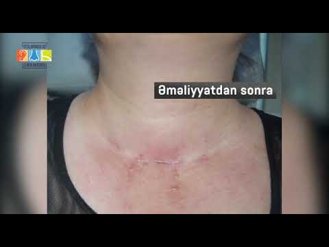 Video: Traxeostomiya Baxımı Necə Edilir (Şəkillərlə birlikdə)