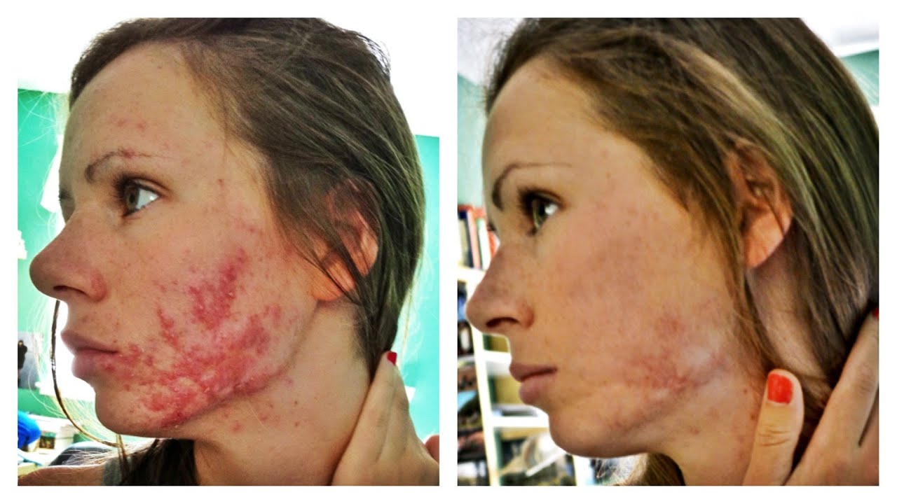 acne after accutane