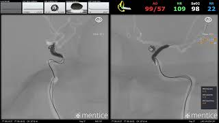 NV Connect | Cerebral Aneurysm Coiling