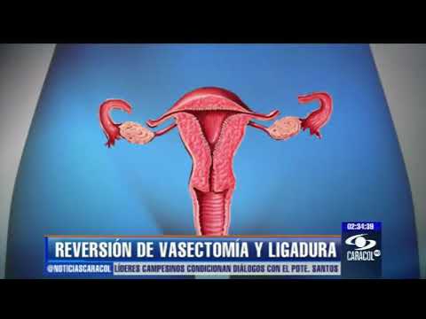 ¿Qué tan fácil es revertir una vasectomía o una ligadura de trompas?