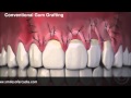 Dr  Peter Young about Pinhole Surgery for treatment receding gums.