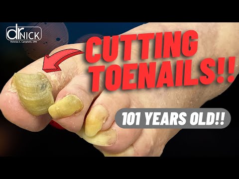 Cutting Fungus Toenails!!😳