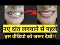 Naye Dant Kaise Lagate Hai |Dental Bridge |Teeth Capping Process |Teeth Cap Cost |Nakli Dant Ka Cost