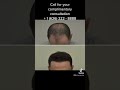 Best Before and After results FUE Hair Transplant LA, Los Angeles, Beverly Hills, San Francisco