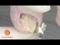 Toenail cleaning with smooth finish for the patient&#39;s comfort and prevent detachments due to hooking