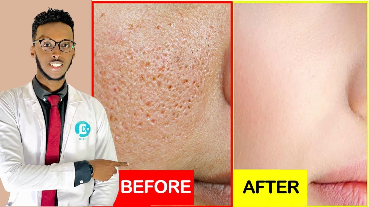 Wajiga Dulduleelka leh iyo sida Dabiiciga Ee loo Daaweeyo | Large Pores