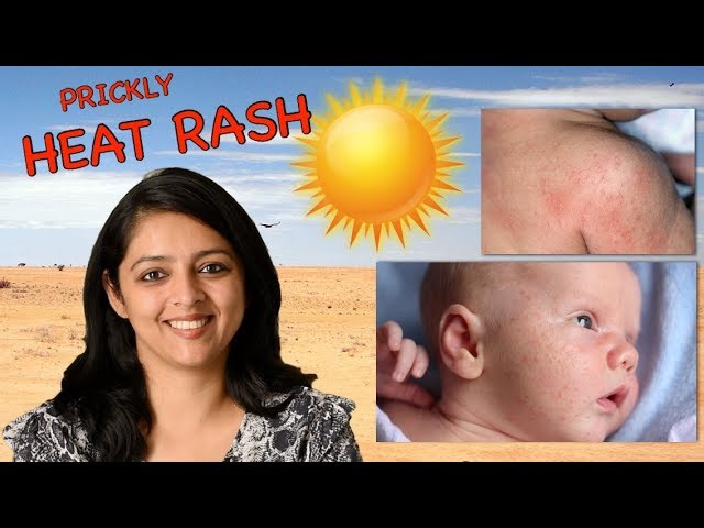 How to get rid of heat rash and prickly heat in children and