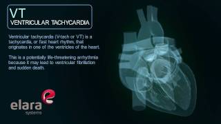 Ventricular Tachycardia Cardiac Arrhythmia 3D Animation