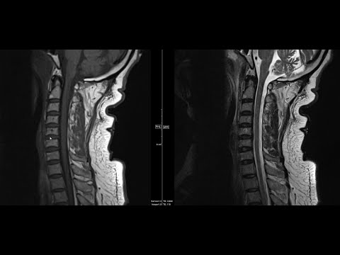 Noncontrast MRI cervical spine search pattern