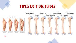Fracturas, Clasificación Y Tips De Tratamiento- Perlas Médicas