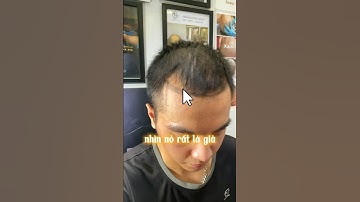 Trán chữ m, hói trán cao , tóc thưa xem hết video nhé #xămtóc #smpvietnam