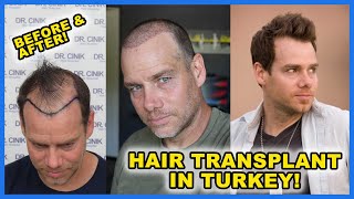 Normal guys gets a HAIR TRANSPLANT in TURKEY! My * Before and After* Hair Transplant Journey!