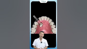 Niềng Răng Kéo Răng Mọc Ngầm Như Nào ?  | Bác Sĩ Yên